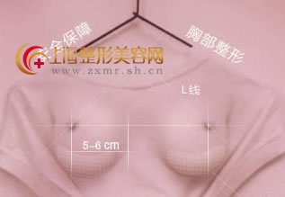 假体隆胸整形手术费用怎么算的